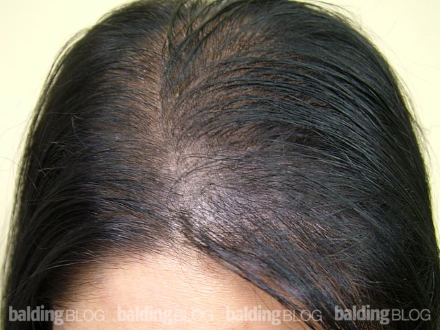 does laser treatment regrow hair